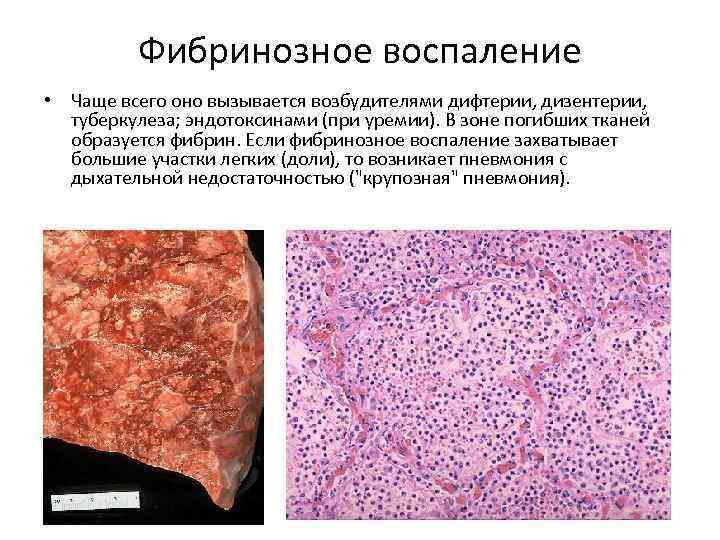 Фибринозное воспаление • Чаще всего оно вызывается возбудителями дифтерии, дизентерии, туберкулеза; эндотоксинами (при уремии).