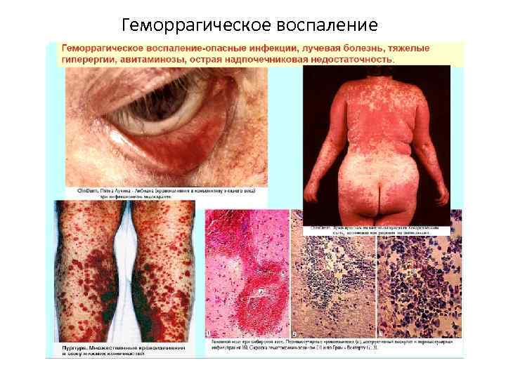 Геморрагическое воспаление 