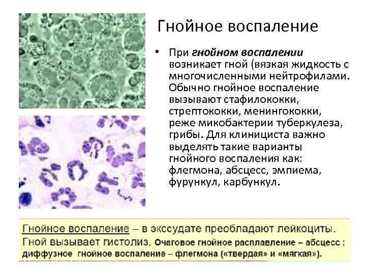 Гнойное воспаление • При гнойном воспалении возникает гной (вязкая жидкость с многочисленными нейтрофилами. Обычно