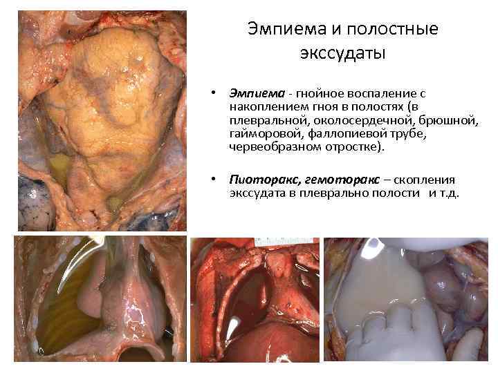 Эмпиема и полостные экссудаты • Эмпиема - гнойное воспаление с накоплением гноя в полостях