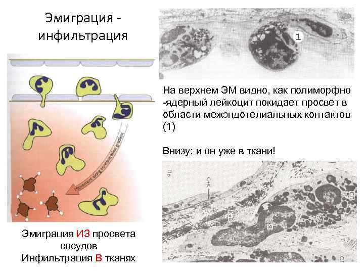 Эмиграция - инфильтрация На верхнем ЭМ видно, как полиморфно -ядерный лейкоцит покидает просвет в