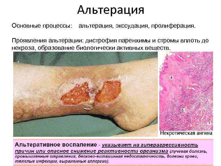 Альтерация Основные процессы: альтерация, экссудация, пролиферация. Проявления альтерации: дистрофия паренхимы и стромы вплоть до