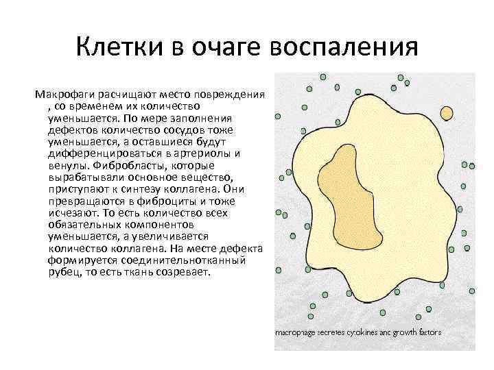 Клетки в очаге воспаления Макрофаги расчищают место повреждения , со временем их количество уменьшается.