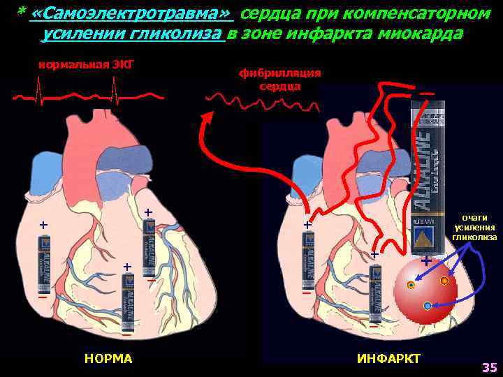 * «Самоэлектротравма» сердца при компенсаторном усилении гликолиза в зоне инфаркта миокарда нормальная ЭКГ фибрилляция