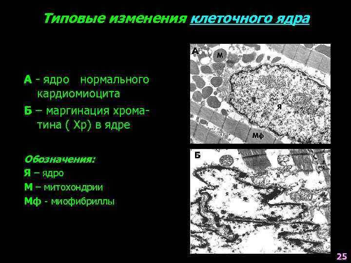 Типовые изменения клеточного ядра А - ядро нормального кардиомиоцита Б – маргинация хроматина (