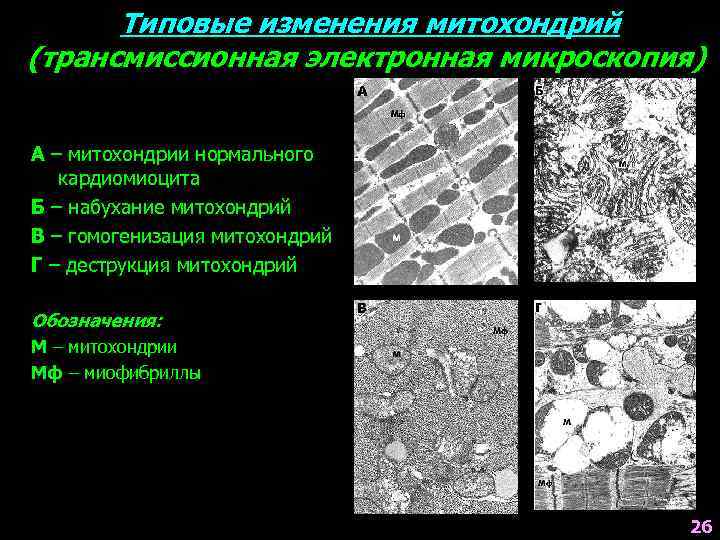 Типовые изменения митохондрий (трансмиссионная электронная микроскопия) А – митохондрии нормального кардиомиоцита Б – набухание