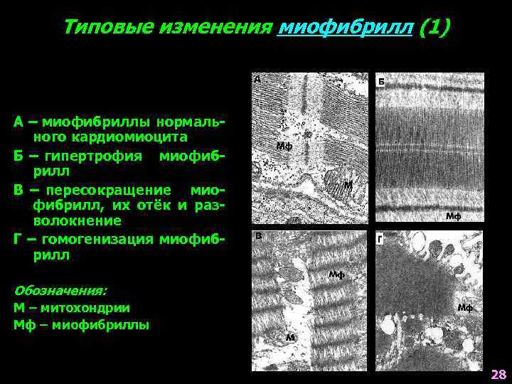 Типовые изменения миофибрилл (1) А – миофибриллы нормального кардиомиоцита Б – гипертрофия миофибрилл В