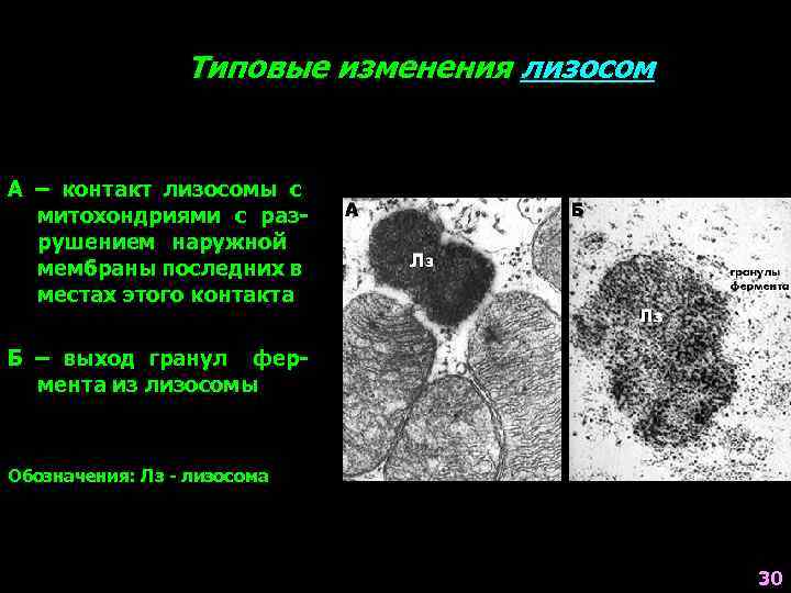 Типовые изменения лизосом А – контакт лизосомы с митохондриями с разрушением наружной мембраны последних