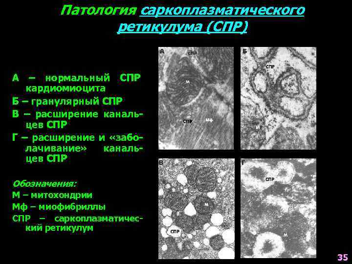 Патология саркоплазматического ретикулума (СПР) А – нормальный СПР кардиомиоцита Б – гранулярный СПР В