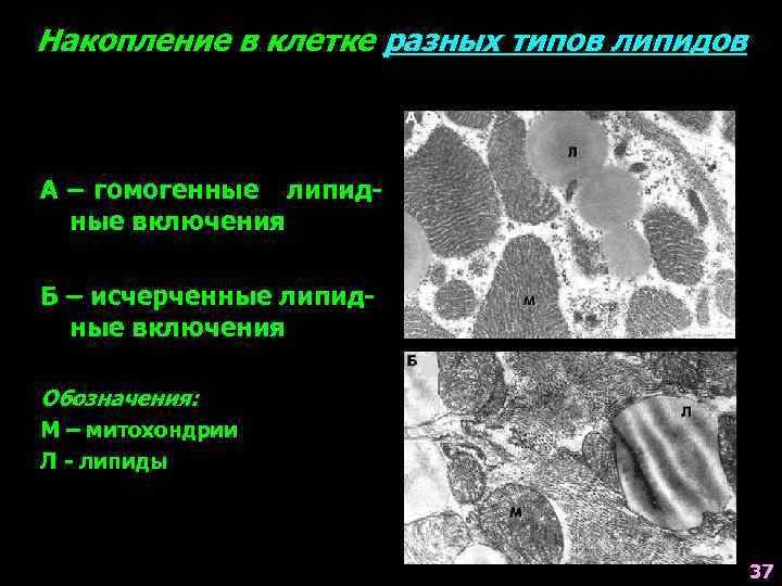 Накопление в клетке разных типов липидов А – гомогенные липидные включения Б – исчерченные