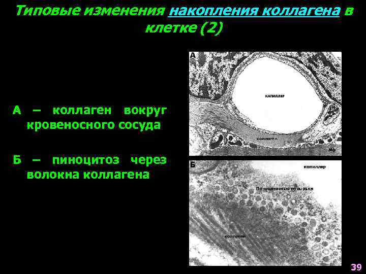 Типовые изменения накопления коллагена в клетке (2) А – коллаген вокруг кровеносного сосуда Б