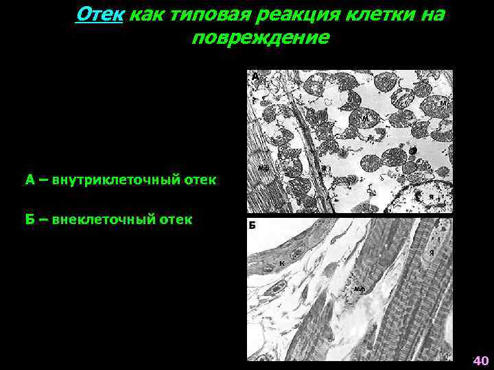 Отек как типовая реакция клетки на повреждение А – внутриклеточный отек Б – внеклеточный