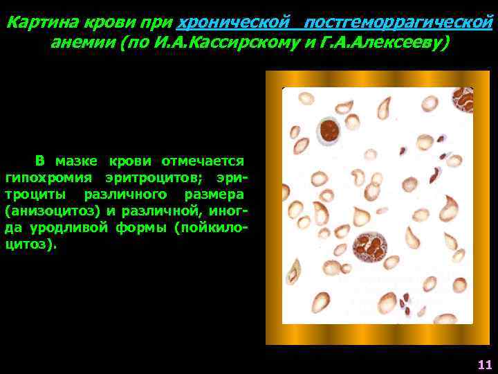 Картина крови при хронической постгеморрагической анемии (по И. А. Кассирскому и Г. А. Алексееву)