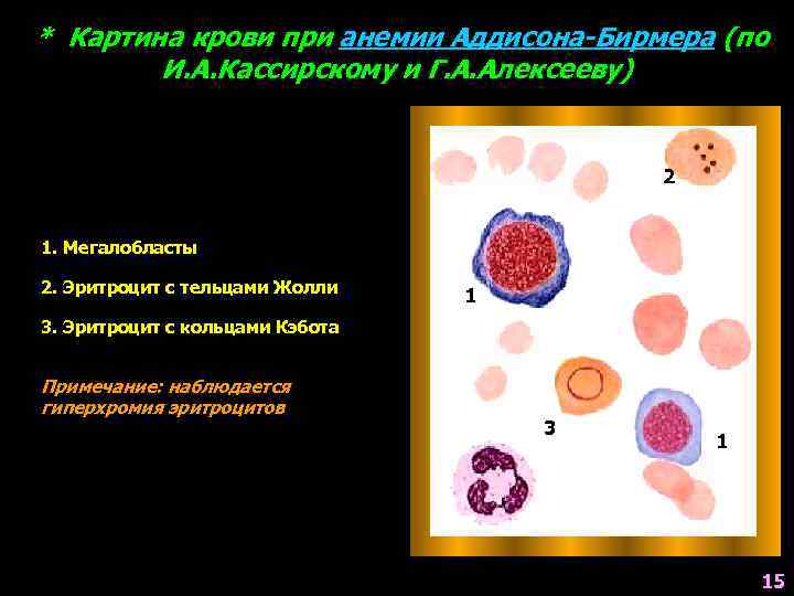 Панмиелофтиз картина крови