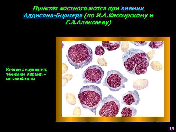Пунктат костного мозга при анемии Аддисона-Бирмера (по И. А. Кассирскому и Г. А. Алексееву)