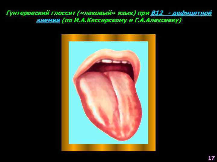 Гунтеровский глоссит ( «лаковый» язык) при В 12 - дефицитной анемии (по И. А.