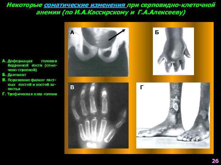 Некоторые соматические изменения при серповидно-клеточной анемии (по И. А. Кассирскому и Г. А. Алексееву)
