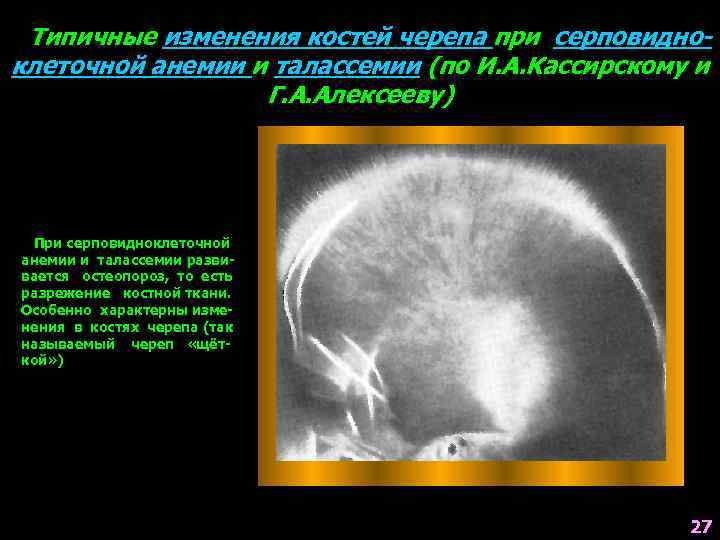 Типичные изменения костей черепа при серповидноклеточной анемии и талассемии (по И. А. Кассирскому и