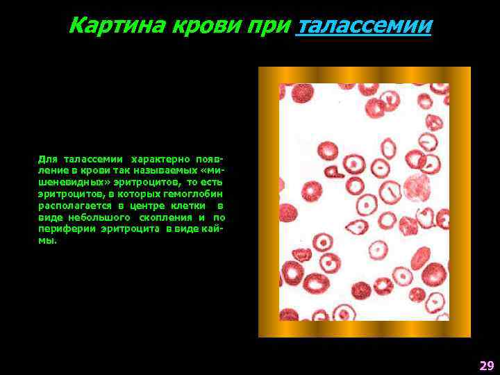 Картина крови при талассемии Для талассемии характерно появление в крови так называемых «мишеневидных» эритроцитов,
