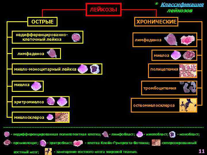 * Классификация лейкозов ЛЕЙКОЗЫ ОСТРЫЕ ХРОНИЧЕСКИЕ недифференцированноклеточный лейкоз лимфаденоз миело-моноцитарный лейкоз полицетемия миелоз тромбоцитемия