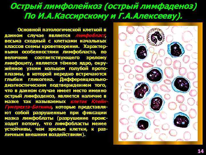 Острый лимфолейкоз (острый лимфаденоз) По И. А. Кассирскому и Г. А. Алексееву). Основной патологической