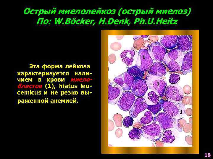 Острый миелолейкоз (острый миелоз) По: W. Böcker, H. Denk, Ph. U. Heitz 1 Эта