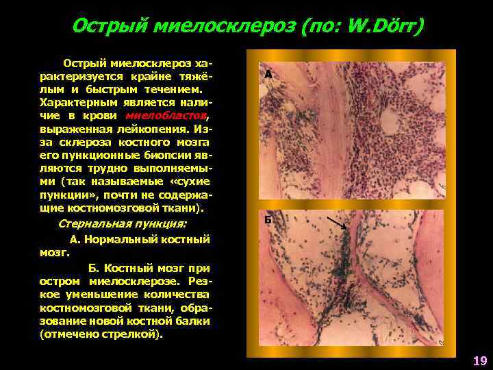 Острый миелосклероз (по: W. Dörr) Острый миелосклероз характеризуется крайне тяжёлым и быстрым течением. Характерным
