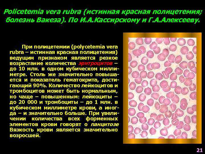 Policetemia vera rubra (истинная красная полицетемия; болезнь Вакеза). По И. А. Кассирскому и Г.