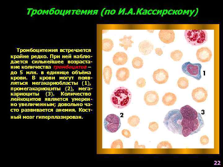 Тромбоцитемия (по И. А. Кассирскому) Тромбоцитемия встречается крайне редко. При ней наблюдается сильнейшее возрастание