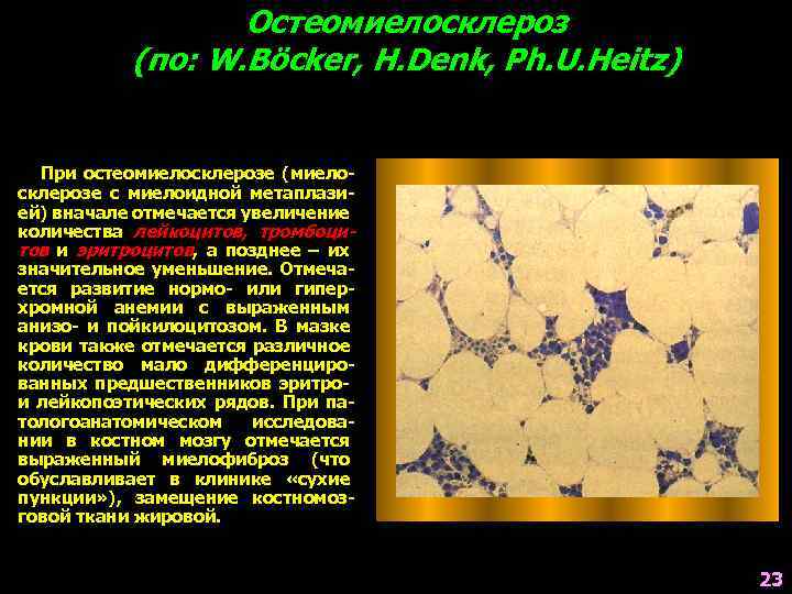 Остеомиелосклероз (по: W. Böcker, H. Denk, Ph. U. Heitz) При остеомиелосклерозе (миелосклерозе с миелоидной