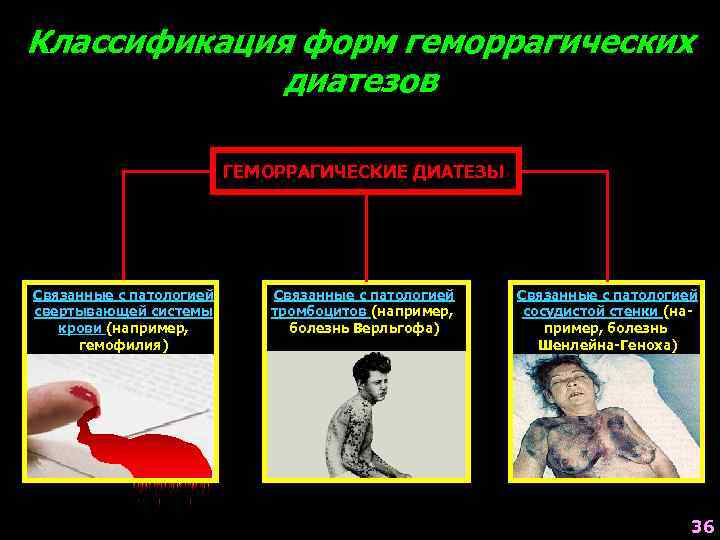 Классификация форм геморрагических диатезов ГЕМОРРАГИЧЕСКИЕ ДИАТЕЗЫ Связанные с патологией свертывающей системы крови (например, гемофилия)