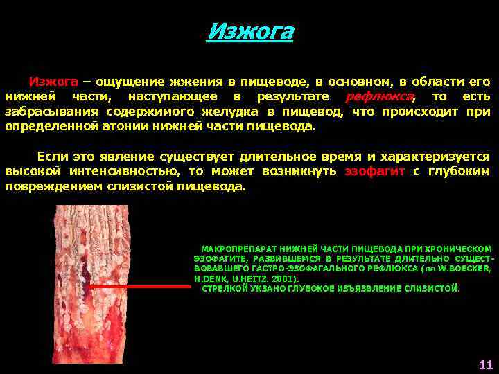 Изжога – ощущение жжения в пищеводе, в основном, в области его нижней части, наступающее