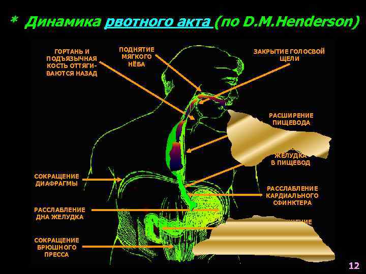 * Динамика рвотного акта (по D. M. Henderson) ГОРТАНЬ И ПОДЪЯЗЫЧНАЯ КОСТЬ ОТТЯГИВАЮТСЯ НАЗАД