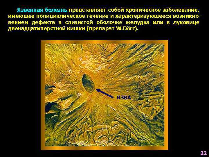 Язвенная болезнь представляет собой хроническое заболевание, имеющее полициклическое течение и характеризующееся возникновением дефекта в