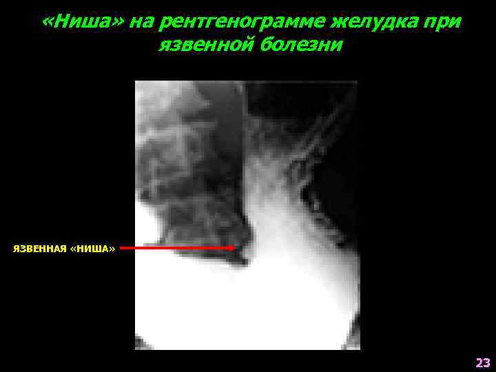  «Ниша» на рентгенограмме желудка при язвенной болезни ЯЗВЕННАЯ «НИША» 23 