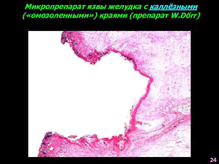 Микропрепарат язвы желудка с каллёзными ( «омозоленными» ) краями (препарат W. Dörr) 24 