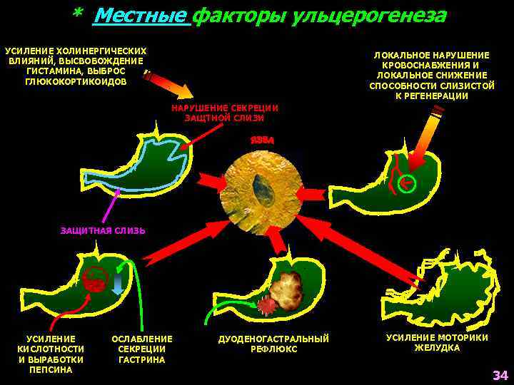 Ульцерогенез. Местные факторы ульцерогенеза. Основные этиологические факторы ульцерогенеза.. Механизмы ульцерогенеза. Теории ульцерогенеза.