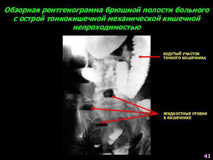Обзорная рентгенограмма брюшной полости больного с острой тонкокишечной механической кишечной непроходимостью ВЗДУТЫЙ УЧАСТОК ТОНКОГО