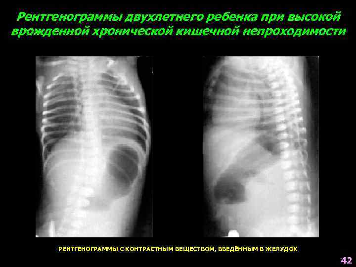 Рентгенограммы двухлетнего ребенка при высокой врожденной хронической кишечной непроходимости РЕНТГЕНОГРАММЫ С КОНТРАСТНЫМ ВЕЩЕСТВОМ, ВВЕДЁННЫМ