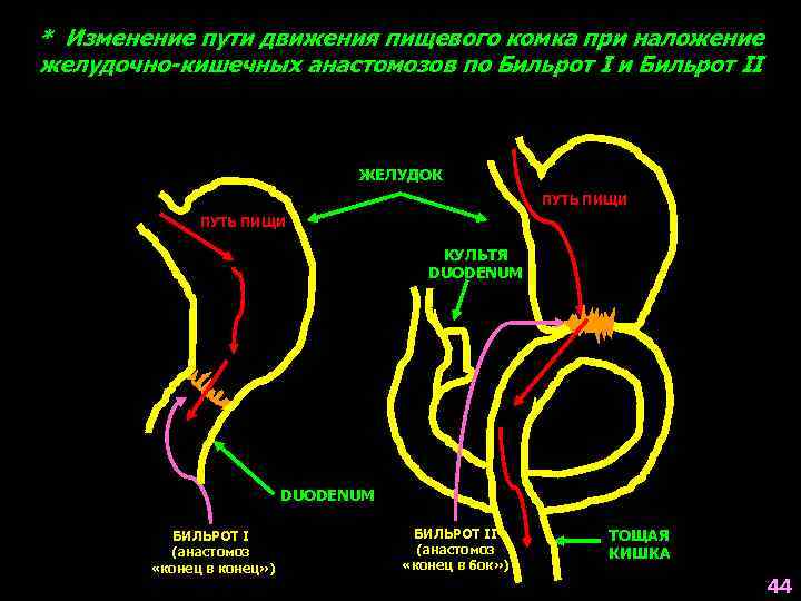 * Изменение пути движения пищевого комка при наложение желудочно-кишечных анастомозов по Бильрот I и