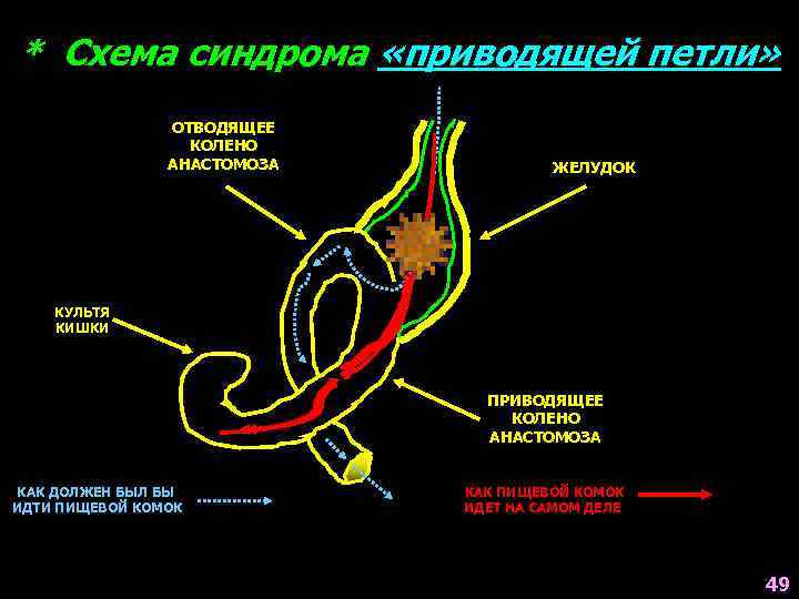 * Схема синдрома «приводящей петли» ОТВОДЯЩЕЕ КОЛЕНО АНАСТОМОЗА ЖЕЛУДОК КУЛЬТЯ КИШКИ ПРИВОДЯЩЕЕ КОЛЕНО АНАСТОМОЗА