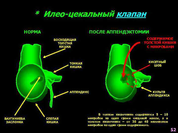 * Илео-цекальный клапан НОРМА ПОСЛЕ АППЕНДЭКТОМИИ СОДЕРЖИМОЕ ТОЛСТОЙ КИШКИ С МИКРОБАМИ ВОСХОДЯЩАЯ ТОЛСТАЯ КИШКА
