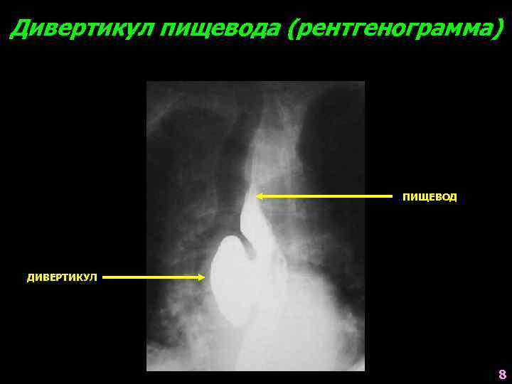 Дивертикул пищевода (рентгенограмма) ПИЩЕВОД ДИВЕРТИКУЛ 8 