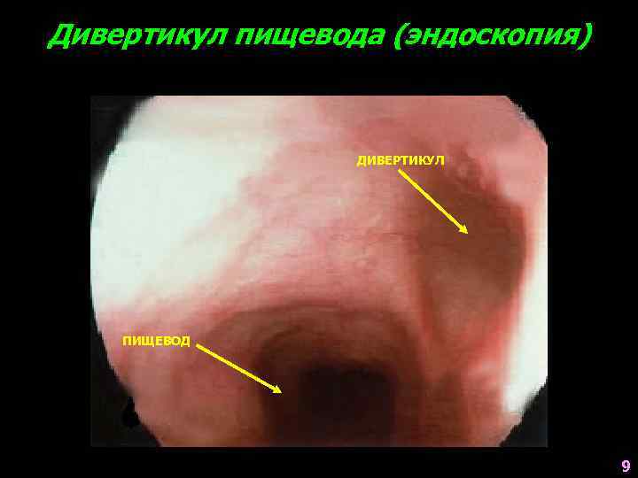 Дивертикул пищевода (эндоскопия) ДИВЕРТИКУЛ ПИЩЕВОД 9 