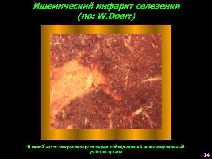 Ишемический инфаркт селезенки (по: W. Doerr) В левой части макропрепарата виден побледневший ишемизированный участок