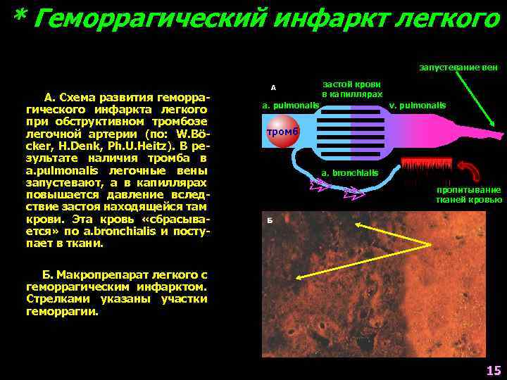 * Геморрагический инфаркт легкого запустевание вен А. Схема развития геморрагического инфаркта легкого при обструктивном