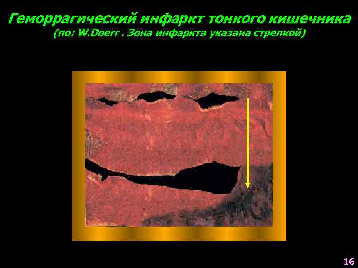 Геморрагический инфаркт тонкого кишечника (по: W. Doerr. Зона инфаркта указана стрелкой) 16 