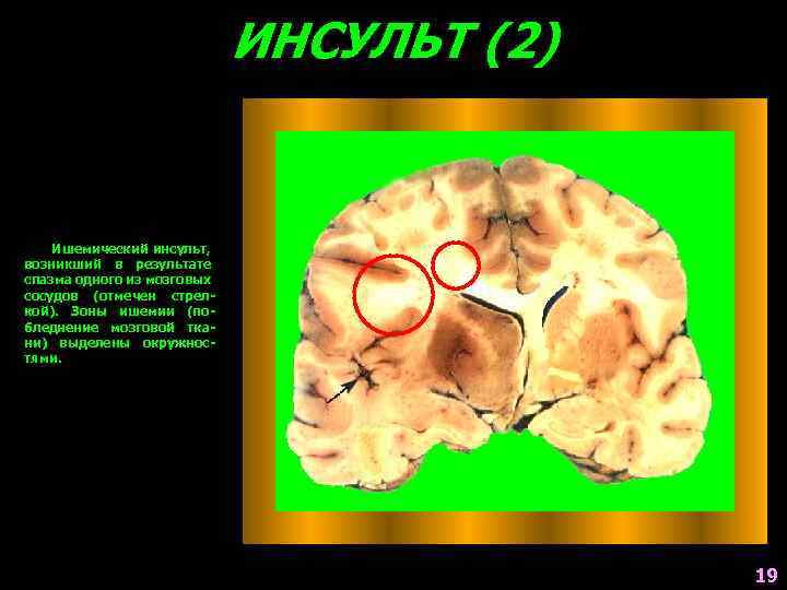 ИНСУЛЬТ (2) Ишемический инсульт, возникший в результате спазма одного из мозговых сосудов (отмечен стрелкой).