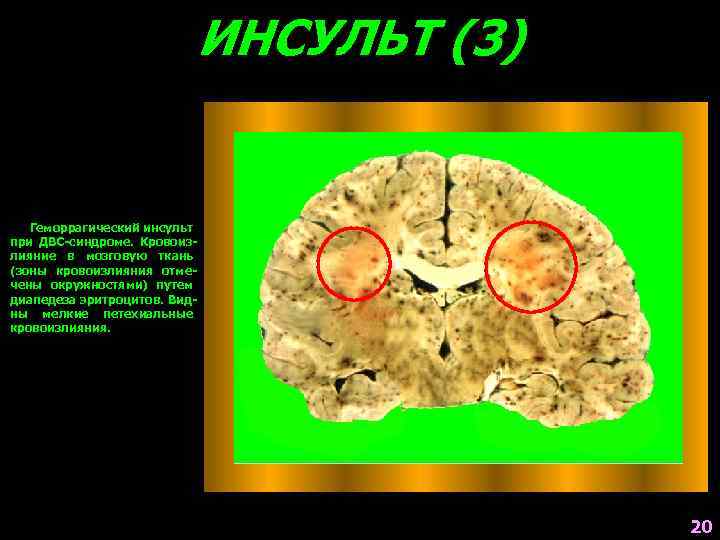 ИНСУЛЬТ (3) Геморрагический инсульт при ДВС-синдроме. Кровоизлияние в мозговую ткань (зоны кровоизлияния отмечены окружностями)