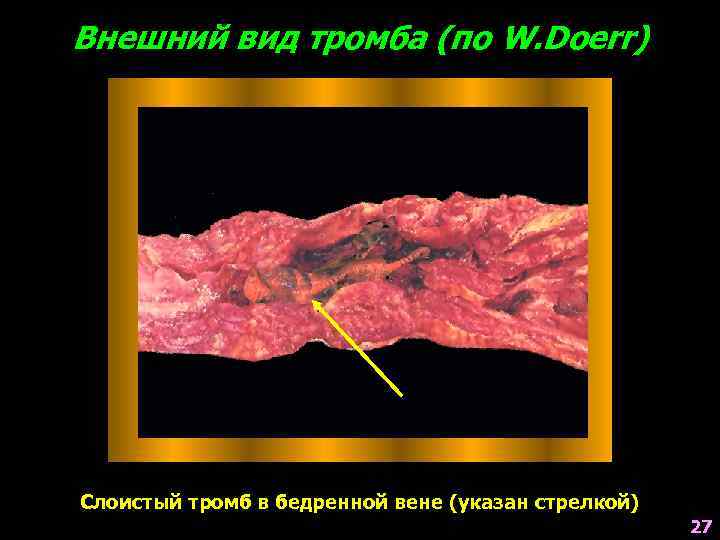 Внешний вид тромба (по W. Doerr) Слоистый тромб в бедренной вене (указан стрелкой) 27